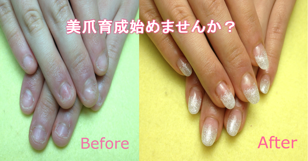 深爪矯正のアクリルスカルプ付ける前と付けた後