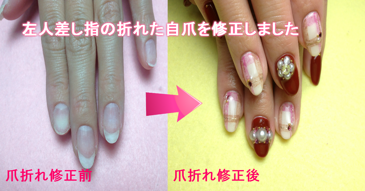 折れた爪をアクリルスカルプで補強