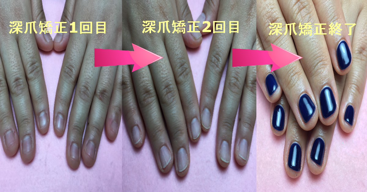 深爪矯正の過程で自爪が伸びる様子