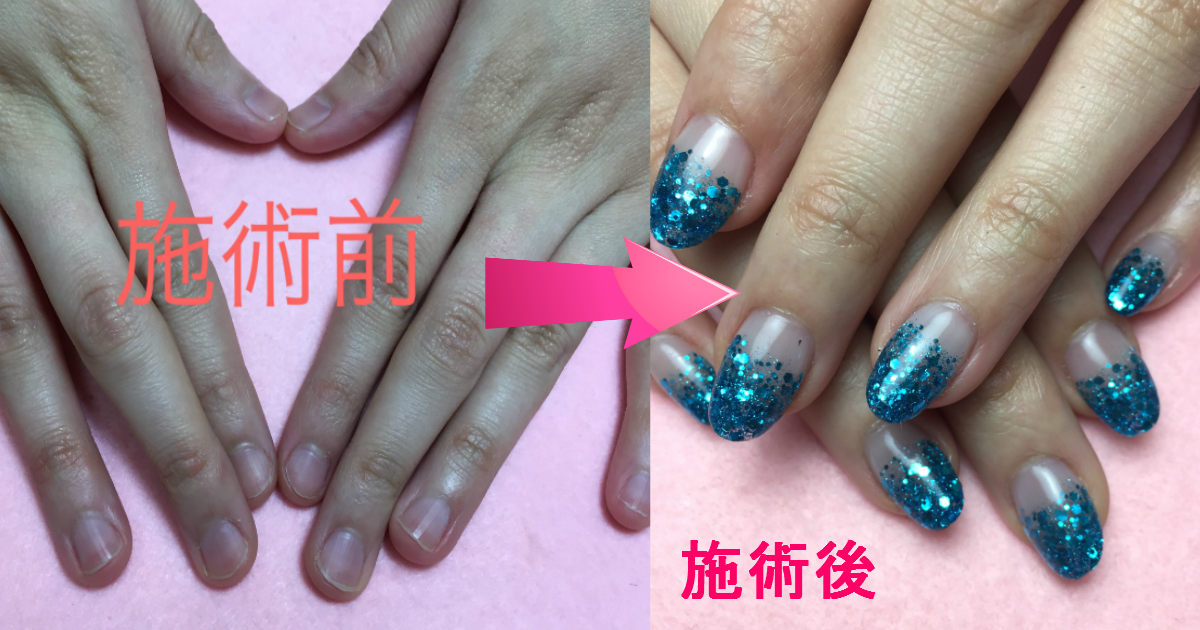 深爪矯正アクリルスカルプ(長さ出し)の施術前と施術後